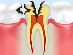 C2象牙質の虫歯